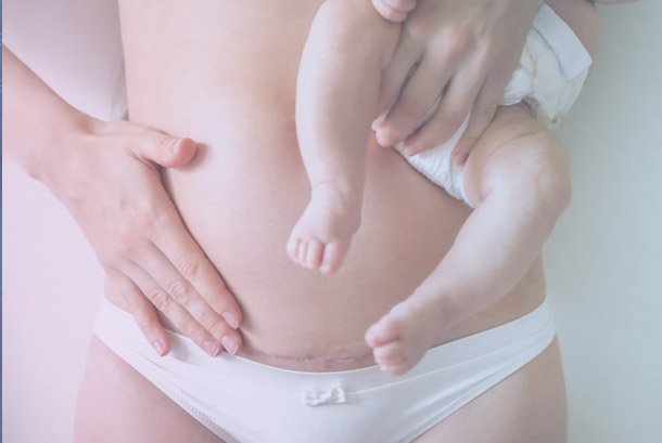  Caesarean section delivery procedure