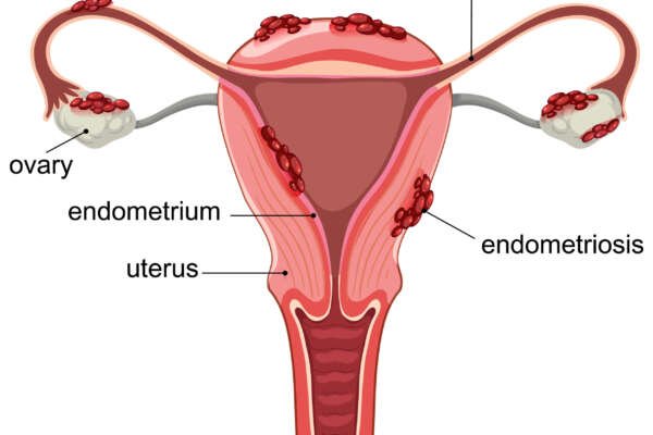 Detailed Medical Illustration of Endometriosis in Uterus Endometriosis